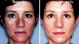 30+ éves hölgy aTriniti arcfiatalító kezelés előtt és az 5. alkalom után