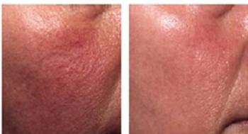 Rosacea kezelése ekőtt és után Rosacea kezelése ekőtt és után