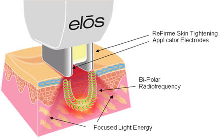 ELOS ReFirm bőrfeszesítő- kollagén termelődést beindító rendszerének lényege