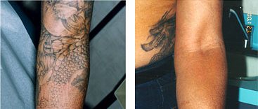 Sikeres tetoválás, tattoo eltávolítása /  képgaléria lent!