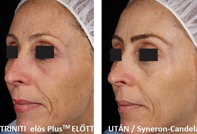 Teljes arcfiatalítás az Elos Plus orvos-esztétikai rendszerrel 3.kép