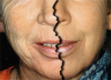Kezelés előt ti ráncos, foltos arc- frakcionális CO2 lézer- kezelés utáni bőrmegújulás 